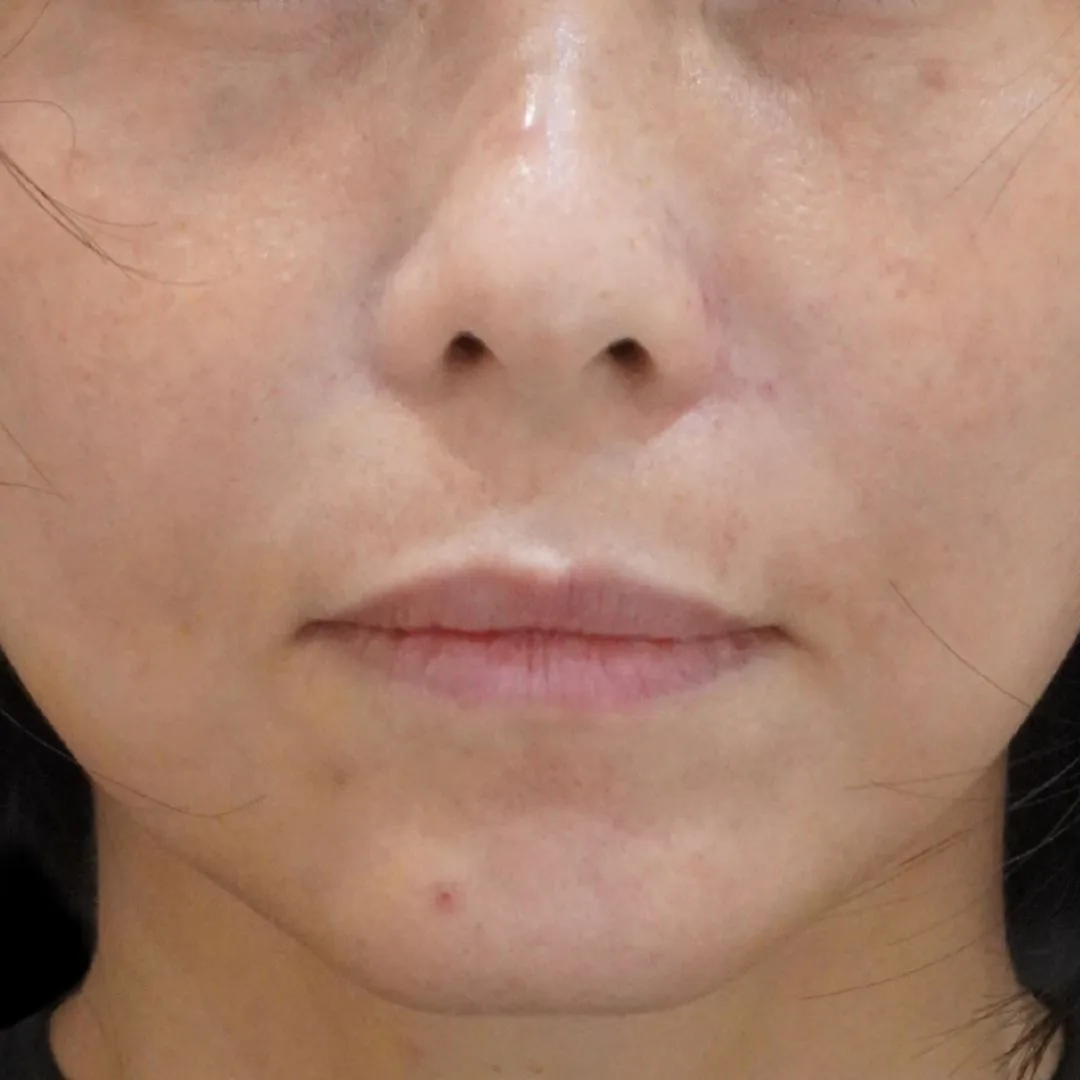Skin booster Petaling Jaya