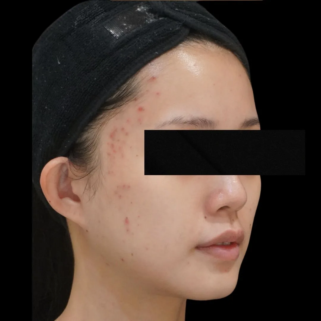 Skin booster Petaling Jaya