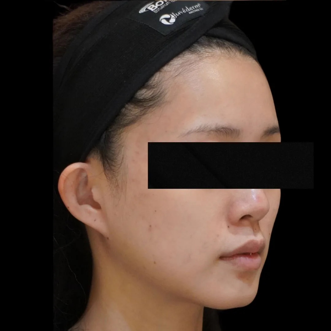 Skin booster Petaling Jaya