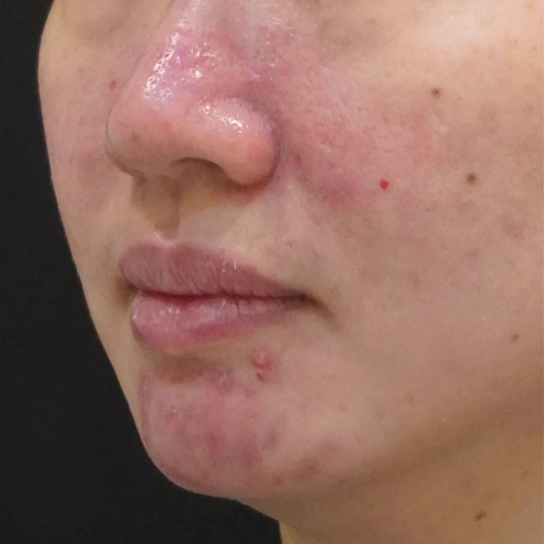Skin booster Petaling Jaya