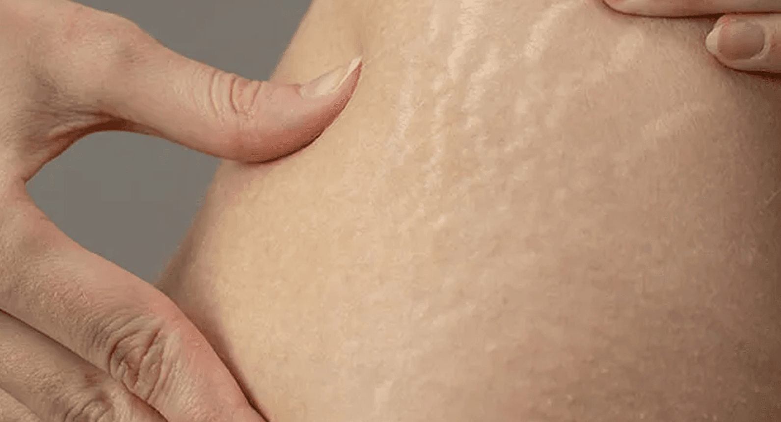 Close-up of stretch marks on the skin