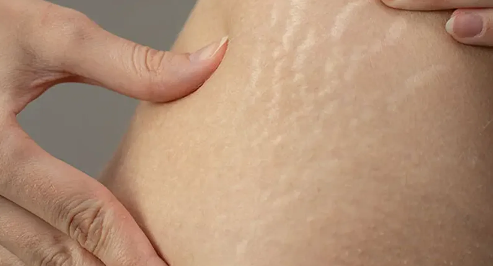 Close-up of stretch marks on the skin