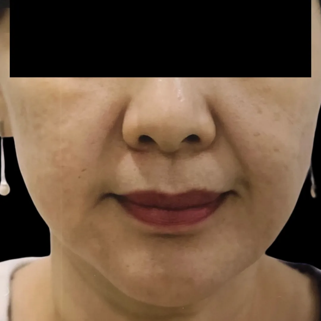 Face Thread Lift (Facial Contouring) (1)