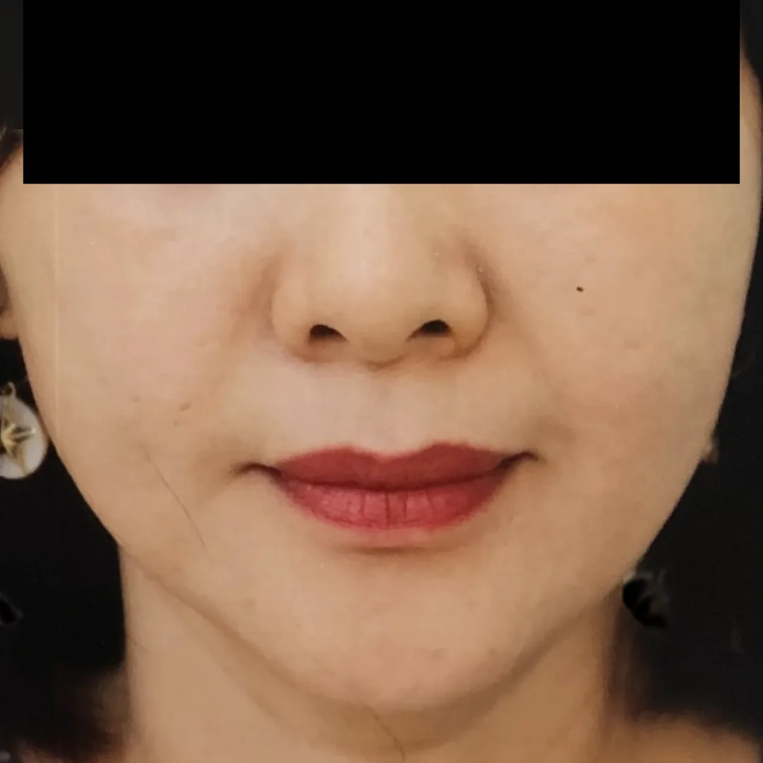 Face Thread Lift (Facial Contouring) (2)