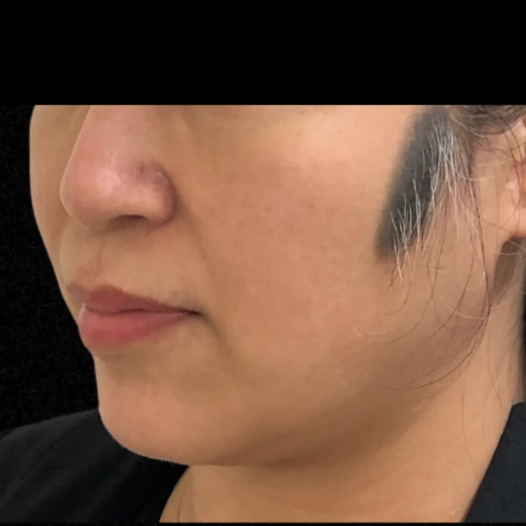 Face Thread Lift (Facial Contouring) (3)
