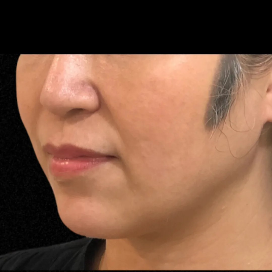 Face Thread Lift (Facial Contouring) (4)