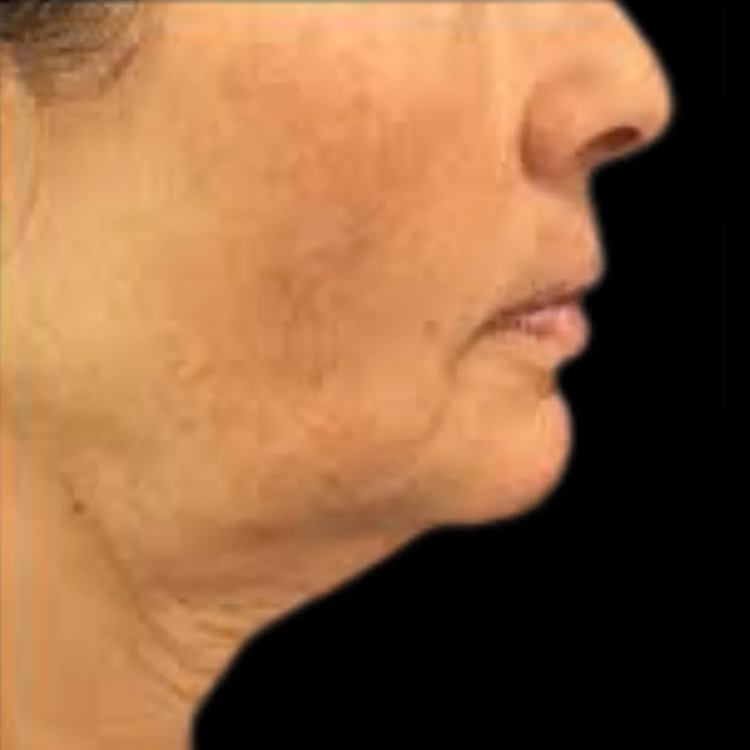 Face Thread Lift (Facial Contouring) (5)