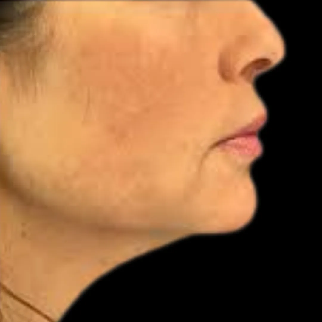Face Thread Lift (Facial Contouring) (6)