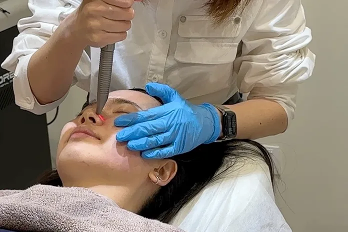 Fotona Laser for Hair Removal Petaling Jaya