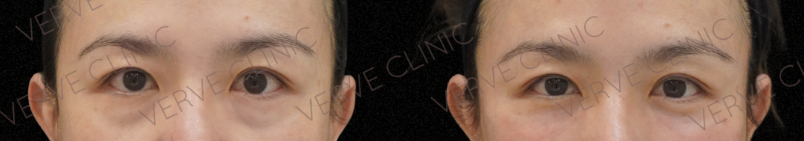 Before and after Deusaderm LIDO collagen treatment for dark circles and eye bags at Verve Clinic