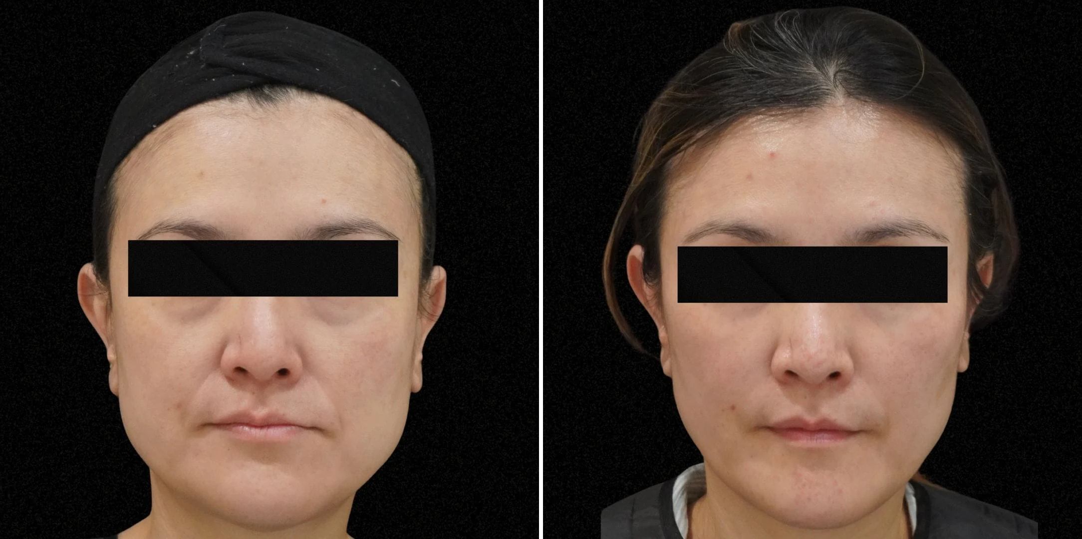 Dermal fillers vs collagen biostimulators: before and after HA filler combined with AestheFill, Verve Clinic Petaling Jaya
