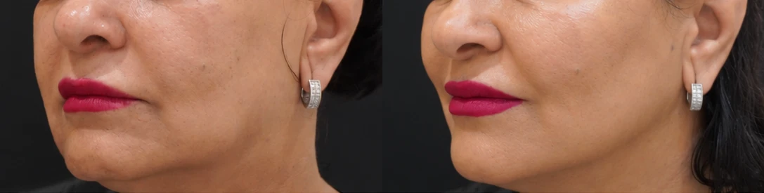 Aptos thread lift before and after, sharper jawline and lifted jowls, Verve Clinic Petaling Jaya