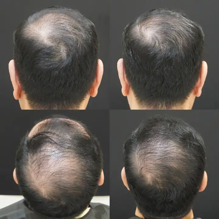 Hair loss treatment before and after for crown thinning in men, Verve Clinic Petaling Jaya