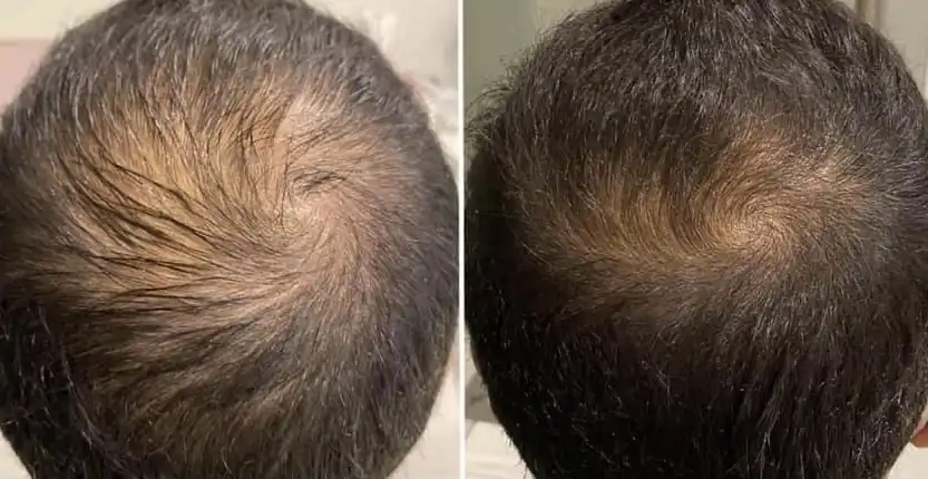 Hair loss treatment before and after 3 sessions, thinning crown, Verve Clinic Malaysia