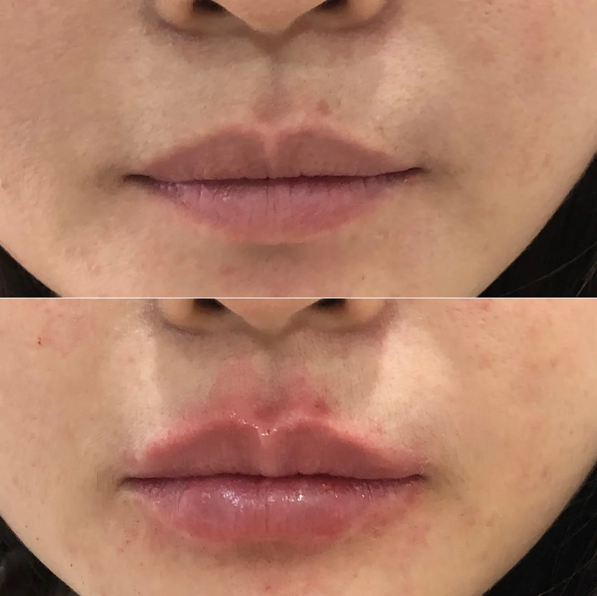 Lip filler before and after, one session, Verve Clinic Petaling Jaya