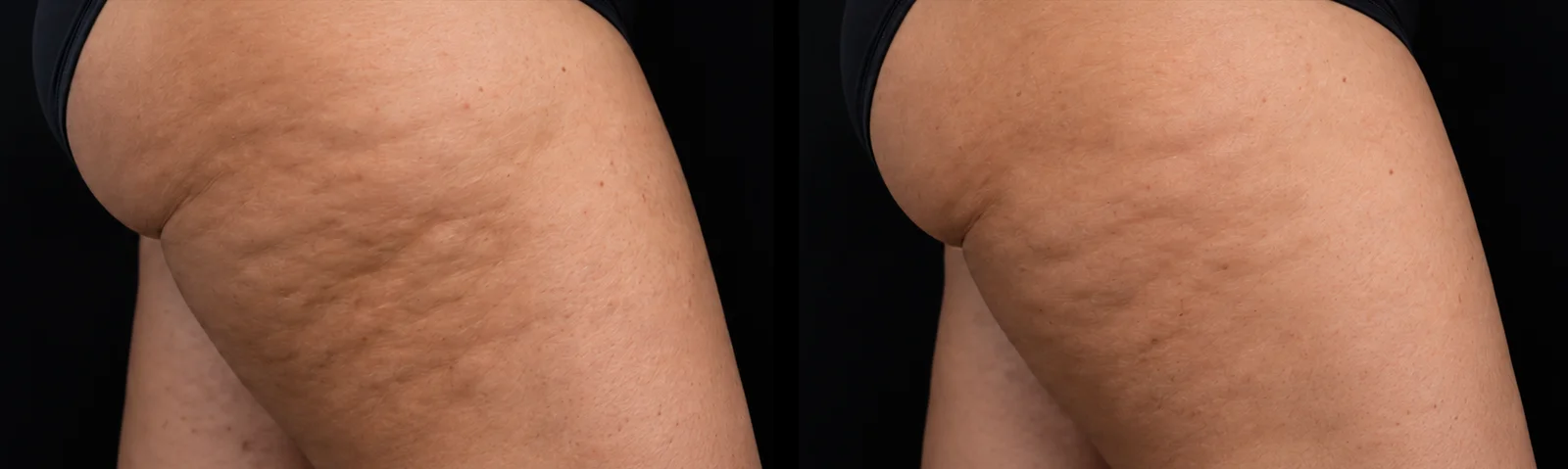 Cellulite on the thigh before and after PB Serum at Verve Clinic Malaysia