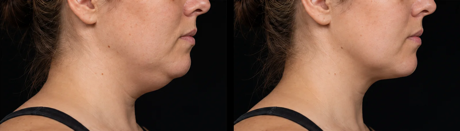 Double chin before and after PB Serum at Verve Clinic, Petaling Jaya