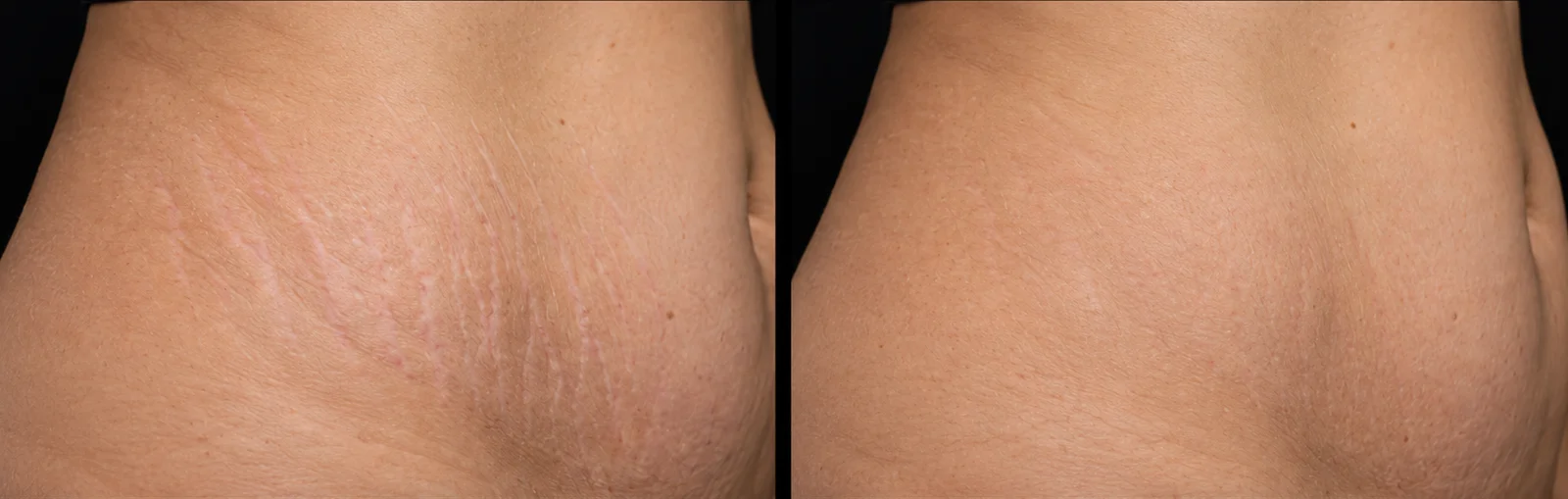 Stretch marks before and after PB Serum at Verve Clinic Malaysia