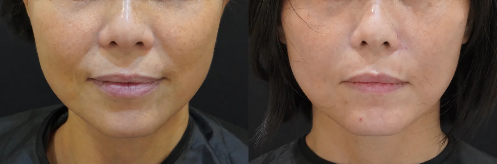 Plinest before and after, 3 sessions, Verve Clinic Petaling Jaya
