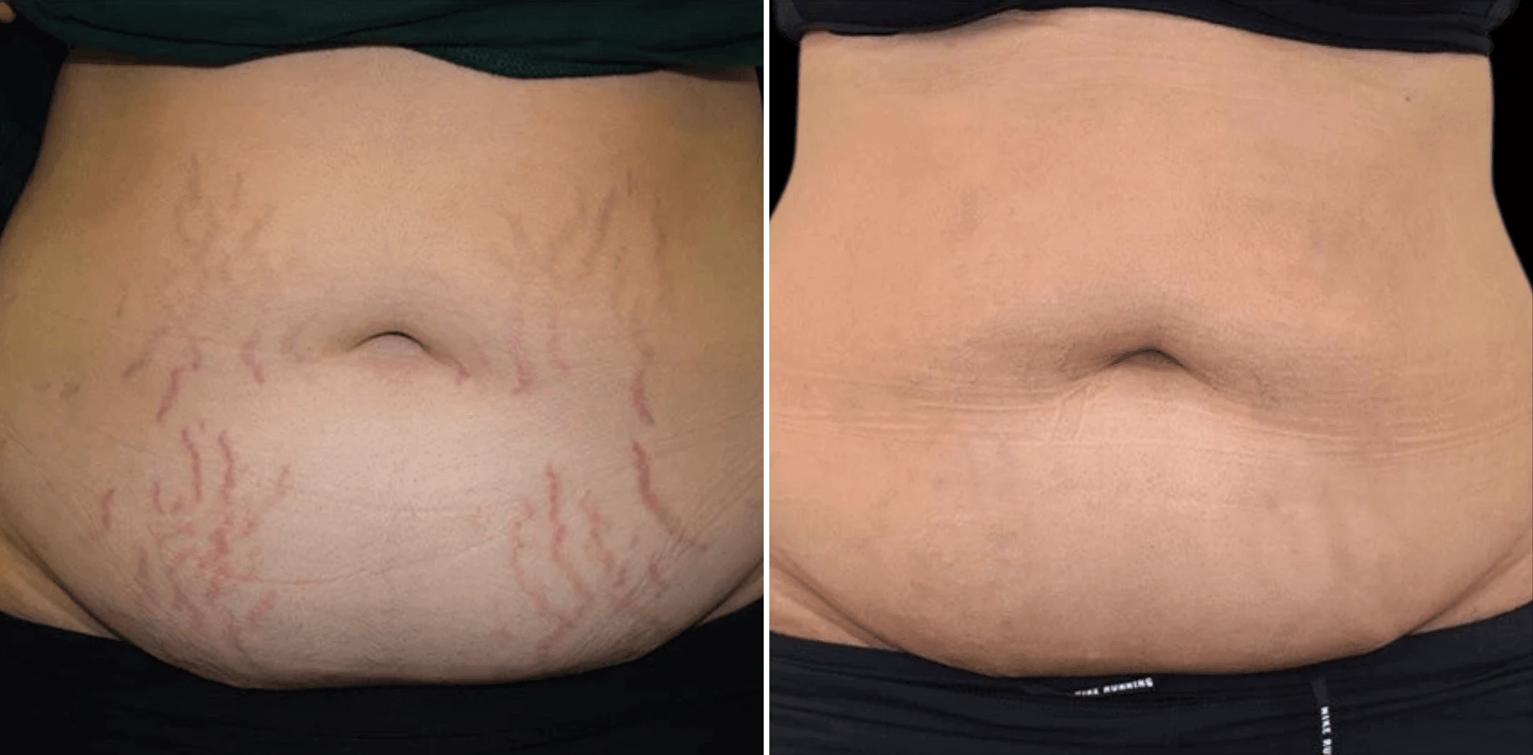 Stretch marks treatment before and after 5 sessions, red stretch marks on the tummy, Verve Clinic Petaling Jaya