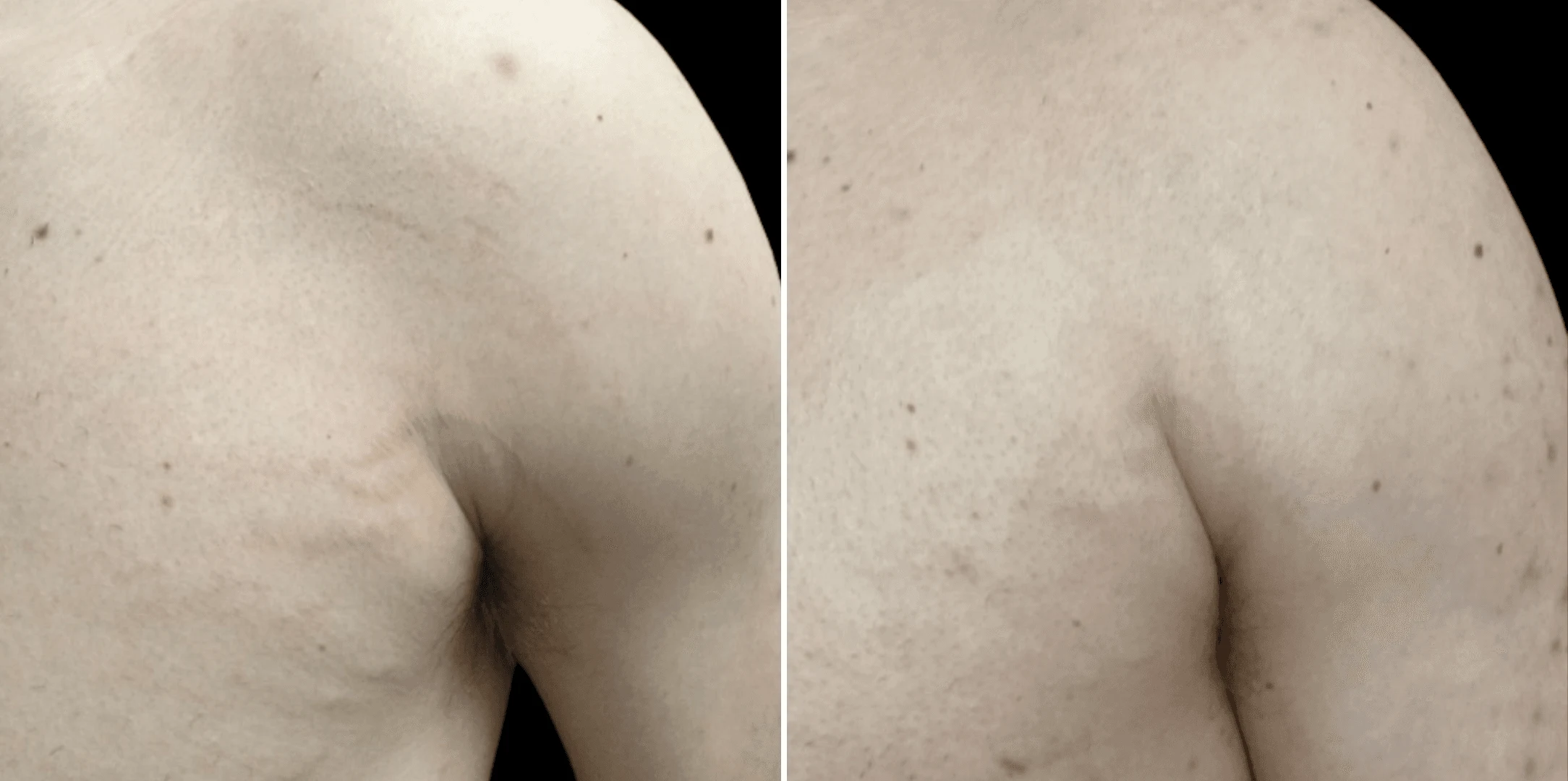 Stretch marks treatment before and after, stretch marks on the shoulder, Verve Clinic Petaling Jaya