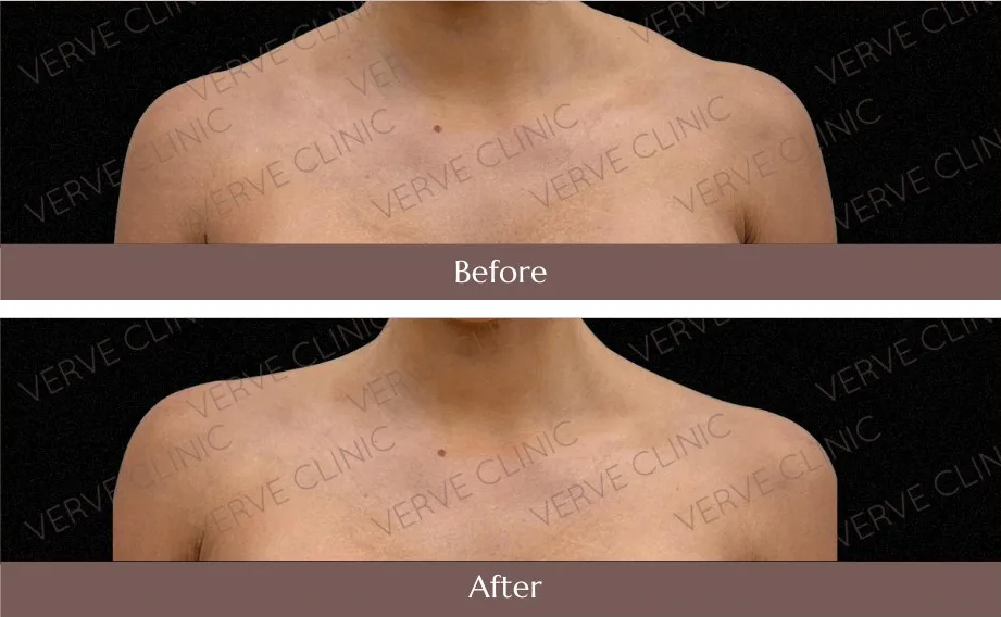 TrapTox before and after, slimmer shoulder line, Verve Clinic Malaysia