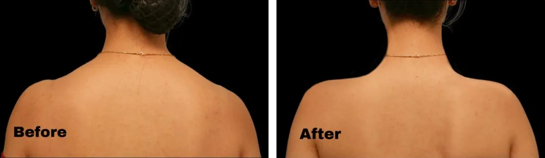 TrapTox shoulder slimming before and after, Verve Clinic Petaling Jaya